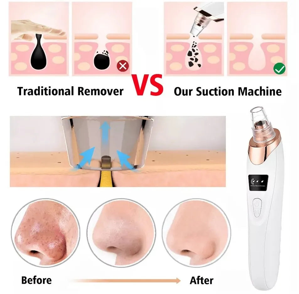 5-in-1 Blackhead Remover Bundle