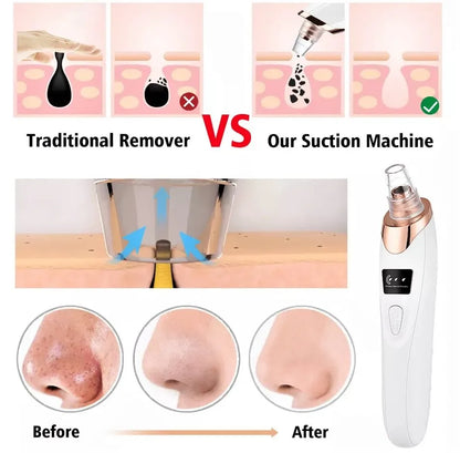 5-in-1 Blackhead Remover Bundle