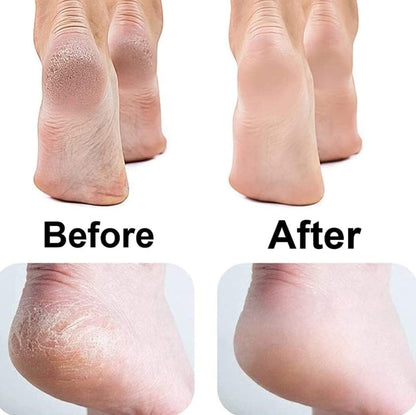 Feet Callus Remover